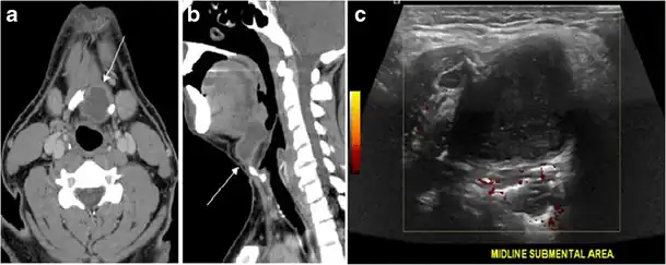 Fig. 20. Recurrent/residual thyroglossal duct cyst in a 39-year-old male patient. The first resection of thyroglossal duct cyst showed histopathology evidence of Hurthle cell type thyroid cancer. However, the second resection showed signs of chronic inflammation, with no malignant cells. a, b Enhanced axial and sagittal neck CT scans demonstrate a unilocular cystic lesion arising from the tongue base and extending through the partially resected hyoid bone. This cystic lesion has a peripheral enhancing wall, which becomes more thick over its inferior aspect associated with surrounding fat stranding at the surgical site (white arrow). There are no internal septations, nodules or masses, or calcifications. c Transverse view of power Doppler ultrasound at the submental area demonstrates cystic lesion and internal debris with no detected internal vascularity.