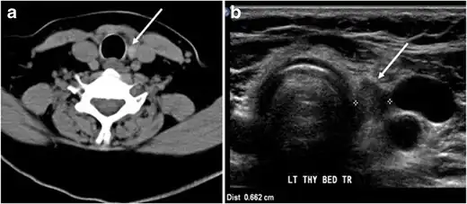 Fig. 7. A 51-year-old female patient post total thyroidectomy for PTC with elevated thyroglobulin measurement. an Axial non-enhanced CT scan of the neck at the level of the thyroid bed demonstrates a well-defined, rounded, homogenously dense soft tissue situated between the trachea and left internal jugular vein (white arrow). b Transverse ultrasound image of the neck demonstrates a well-defined, homogeneous, hypoechoic soft tissue nodule measuring 6&nbsp;mm (white arrow) with no detected micro-calcifications. Biopsy showed a predominantly residual normal thyroid tissue with micro-foci of PTC.