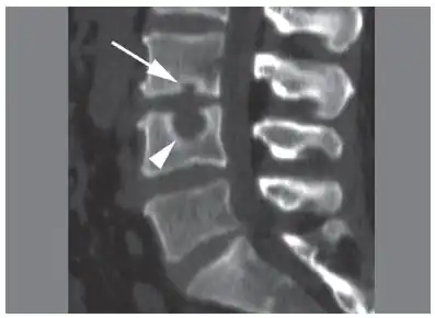 CT scan in the sagittal plane of two Schmorl's nodes. The small Schmorl's node at the inferior endplate of the L3 vertebral body (arrow) has typical features, being broad-based at the endplate, with well-defined contours and thin marginal sclerosis. A large and less typical Schmorl's node (arrowhead) is observed at the superior endplate of L4.[3]