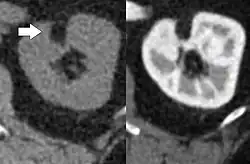 CT scan of a renal angiomyolipoma. It involves the renal cortex, and has an attenuation of less than 20 HU on the Hounsfield scale, which are typical characteristics.[8]