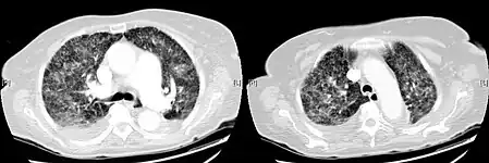 CT, showing extensive pulmonary parenchymal involvement consisting of irregular septal thickenings with ground-glass areas and centrilobular nodules with a peri-lymphatic distribution