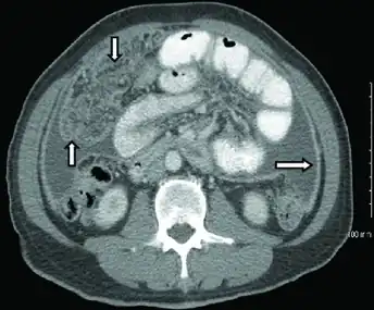 CT scan of peritoneal tuberculosis, a form of extrapulmonary tuberculosis. The omentum and peritoneal surfaces are thickened (arrows).<ref name="AkceBonner2014">Akce M, Bonner S, Liu E, Daniel R (2014). "Peritoneal tuberculosis mimicking peritoneal carcinomatosis". Case Reports in Medicine. 2014: 436568. doi:10.1155/2014/436568. PMC&nbsp;3970461. PMID&nbsp;24715911.