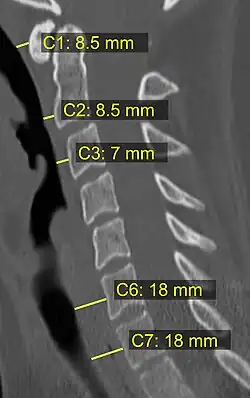 CT scan with upper limits of the thickness of the prevertebral space at different levels