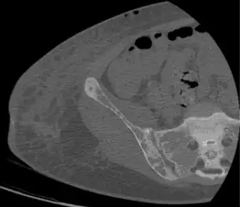Subchondral resorption in the sacroiliac joint.[17]