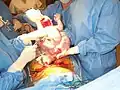 Complete extraction of the baby from the uterus