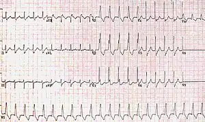 RBBB with associated tachycardia
