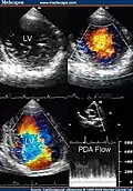 Transthoracic two-dimensional study with color and continuous wave Doppler shows left ventricular noncompaction associated with patent ductus arteriosus (PDA).
