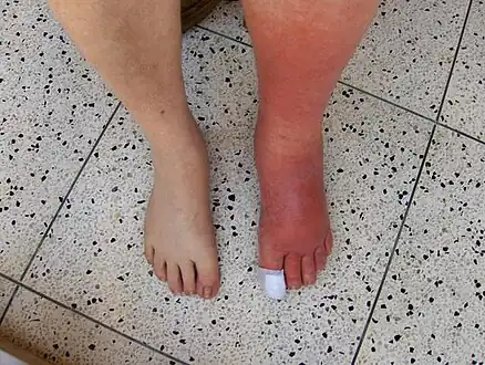 Cellulitis rash