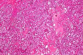 Micrograph of cerebellar hemangioblastoma. HPS stain.