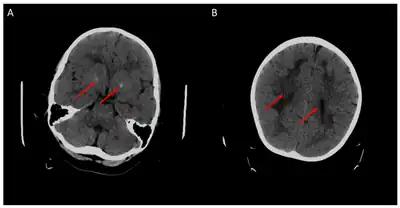 Cerebral CT-scan at 4 years old. Red arrows show brain calcifications (A) and diffuse white matter abnormalities (B). From Mafi et al., 2020[15]