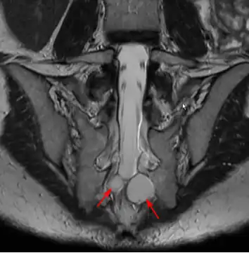 MRI image showing a Tarlov cyst