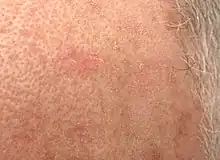 Close-up view of an actinic keratosis lesion