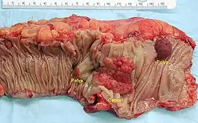 Gross appearance of an opened colectomy specimen containing two adenomatous polyps (the brownish oval tumors above the labels, attached to the normal beige lining by a stalk) and one invasive colorectal carcinoma (the crater-like, reddish, irregularly-shaped tumor located above the label)