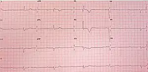 12-lead ECG showing complete heart block
