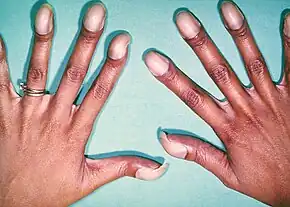 Cyanosis in darker skin. Note the pale purple (instead of the typical bluish-purple hue) nail beds. Also prominent digital clubbing due to a congenital heart disease with right-to-left shunting (they had Tetralogy of Fallot).