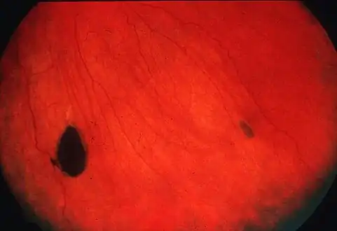 CHRPE - Congenital hypertrophy of the retinal pigment epithelium