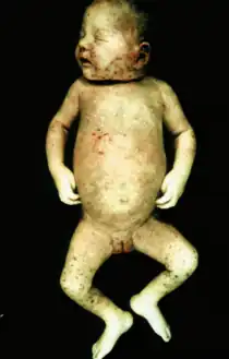 Congenital varicella syndrome