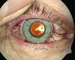 Dilated blood vessels in the eye in CCF [1]