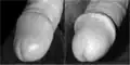 The glans penis of an uncircumcised male and a circumcised male