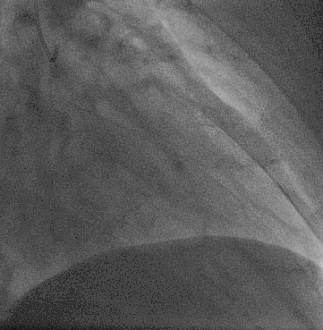 This is a representative video of coronary angiography. While it does not display SCAD, it highlights the technique used to identify the condition.