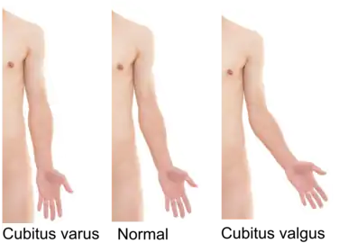 Cubitus varus and cubitus valgus.