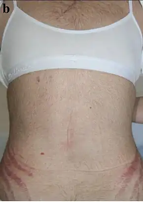 Increased hair and stria in a person with medication-induced Cushing's syndrome[1]