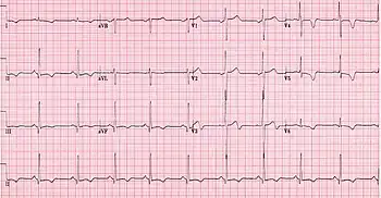 ECG showing HOCM