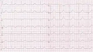 Long QT syndrome