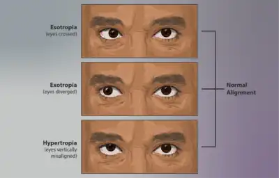 Strabismus is a condition where the eyes are not aligned correctly, also known as "crossed-eyes." It is a common facial symptom of SCARF.[7]