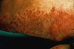 Skin candidiasis