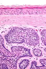 Micrograph of dermal cylindroma in H&E stain.