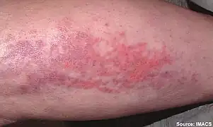 Forearm rash