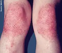 Gottron's papules on a person with juvenile DM