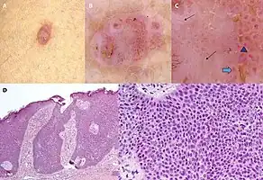Dermoscopy and histopathology of eccrine poroma: (A) Clinical presentation of a nonpigmented eccrine poroma sensu stricto as a pink nodule located on the foot (B,C) Dermoscopy shows milky red areas (light blue arrow), milky red globules (dark blue triangle), and dotted vessels (black arrow) (original magnifications ×20 and ×40, respectively). (D,E) Histopathologically, the neoplasm consists of poroid and cuticular cells and tubular structures that are continuous with the epidermis (H&E stain, original magnifications ×10 and ×40, respectively).[6]