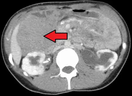 Desmoid tumor