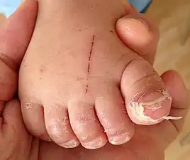 Skin peeling in hand foot and mouth disease