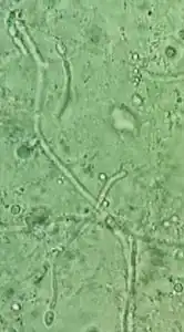 Vaginal wet mount in candidal vulvovaginitis, showing slings of pseudohyphae of Candida albicans. A chlamydospore is visible at left.