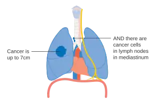 Stage IIIA lung cancer