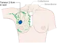 Stage 2A breast cancer