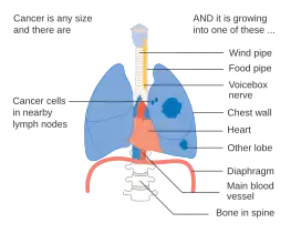 Stage IIIA lung cancer