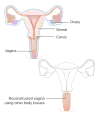 A radical hysterectomy for vaginal cancer with reconstruction of the vagina using other tissues