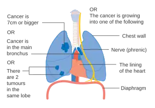 One option for stage IIB lung cancer, with T2b; but if tumor is within 2&nbsp;cm of the carina, this is stage 3