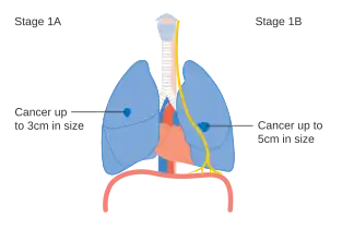 Stage IA and IB lung cancer