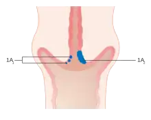 Stage 1A cervical cancer