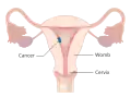 Stage I choriocarcinoma