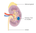 Stage 1 kidney cancer