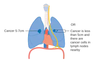 Stage IIA lung cancer