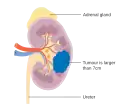 Stage 2 kidney cancer