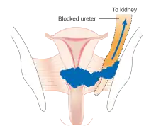 Stage 3B cervical cancer