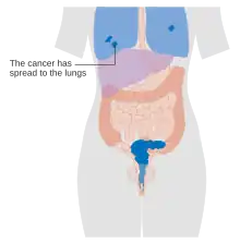 Stage 4B cervical cancer